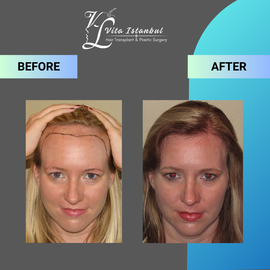 Hair Transplant For Women
