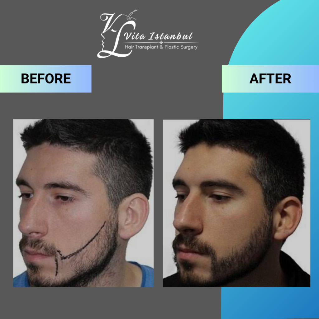 Services 8 Vita Istanbul Beard Transplant 2