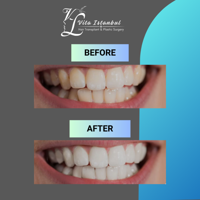 Vita Istanbul Teeth Whitening 2