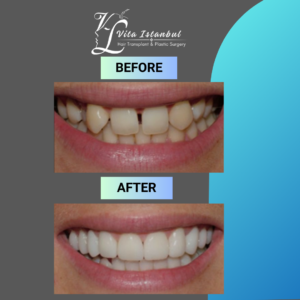 Vita Istanbul Veneers 3