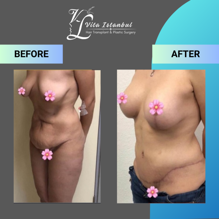 abdominoplasty breast augmentation