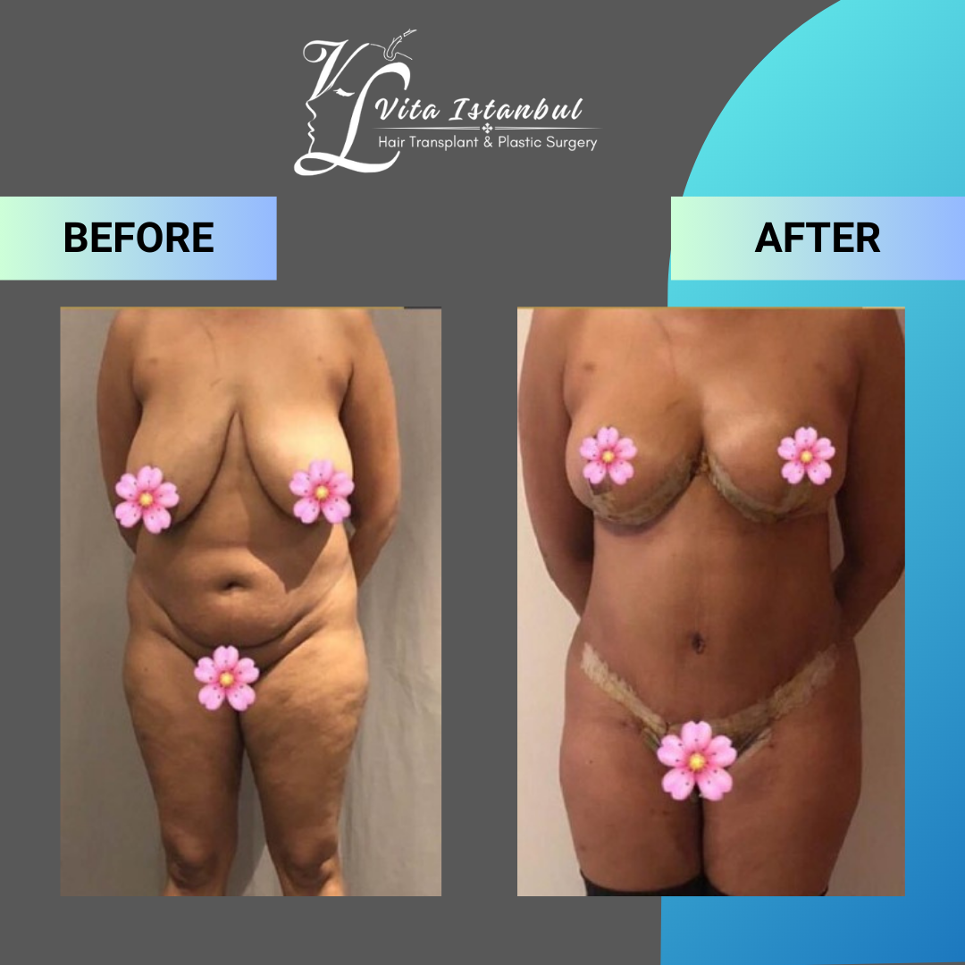 Genital Plastic Surgery