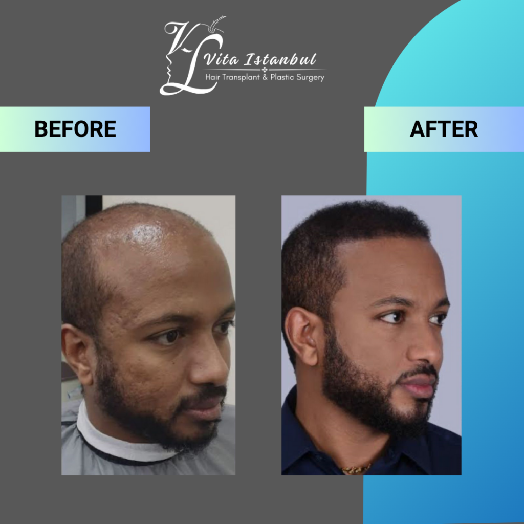 Services 10 Vita Istanbul Afro Hairtransplant 1