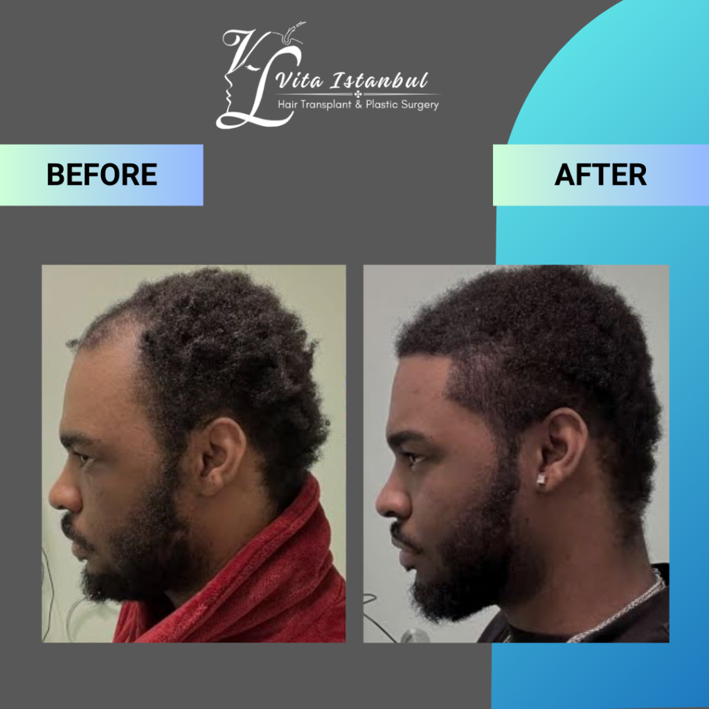 Services 11 Vita Istanbul Afro Hairtransplant 2