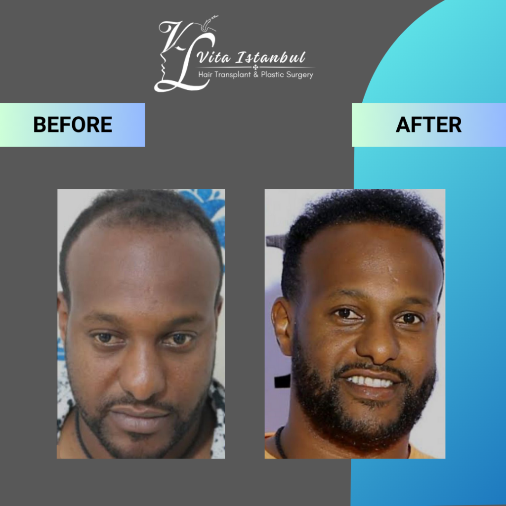 Services 12 Vita Istanbul Afro Hairtransplant 3