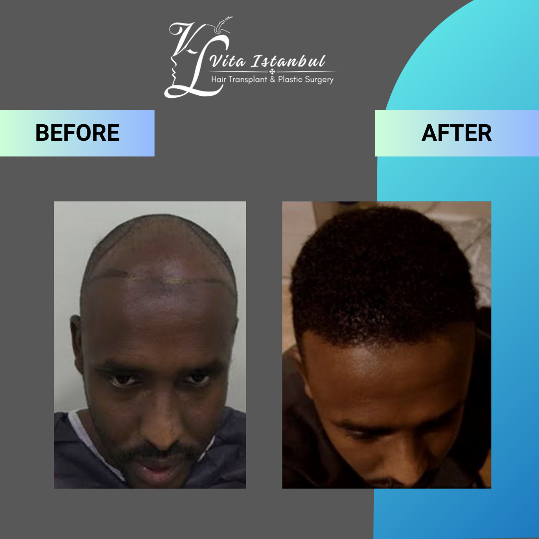 Afro Hair Transplant