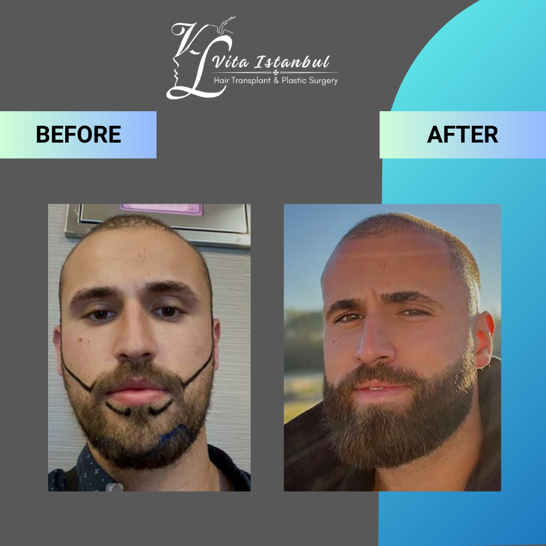 Services 5 Vita Istanbul Beard Transplant 1
