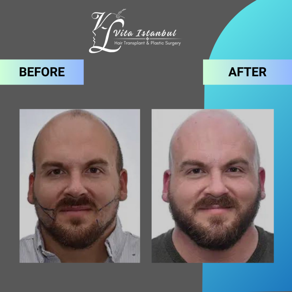 Services 6 Vita Istanbul Beard Transplant 3