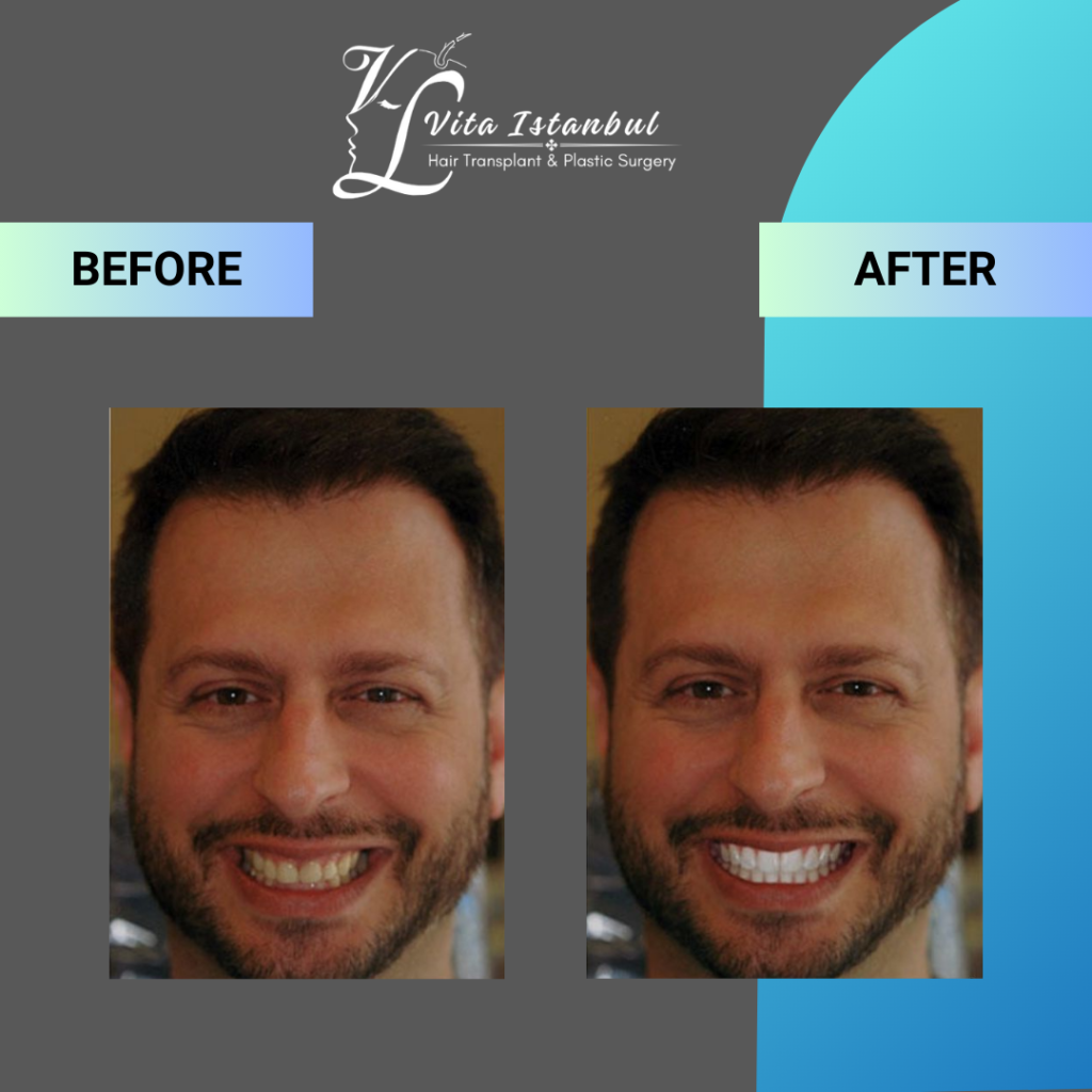 Vita Istanbul Veneers 2