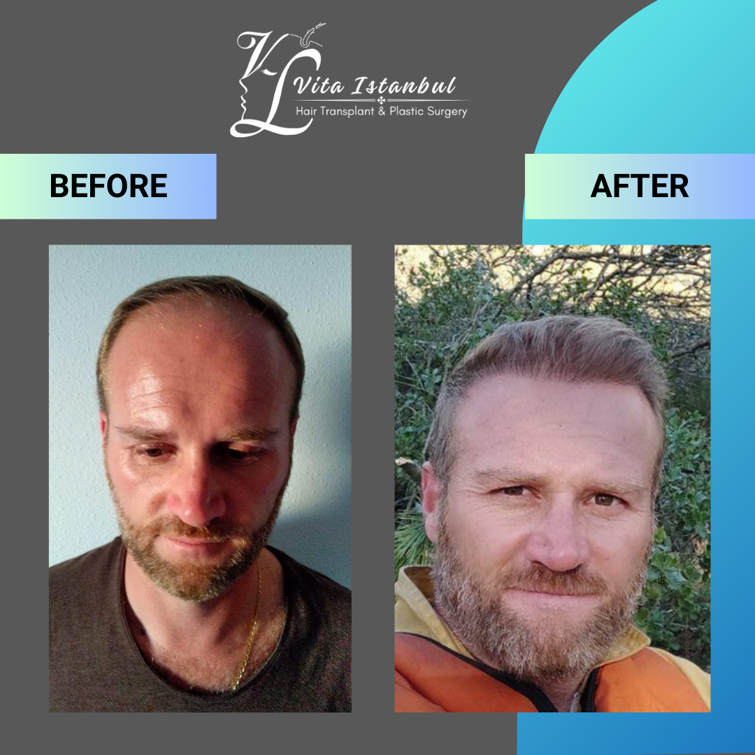 hair transplant before after 11